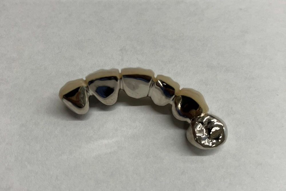 クラウン（歯冠修復）