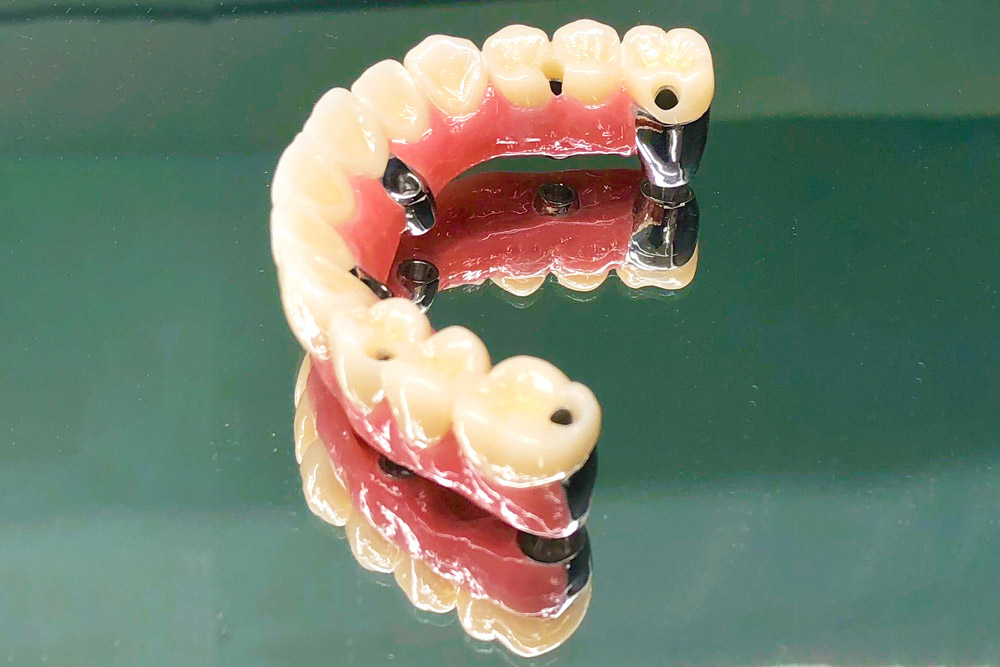 インプラント補綴