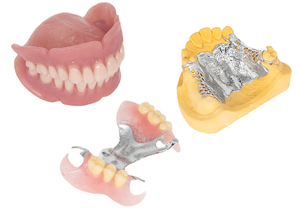 インプラント補綴